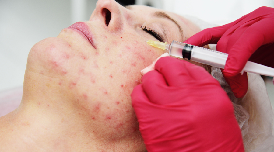 PRP Therapy