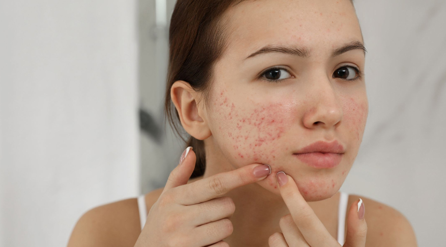 Acne Treatment in Jaipur