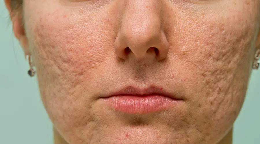 Acne Scar Treatment in jaipur
