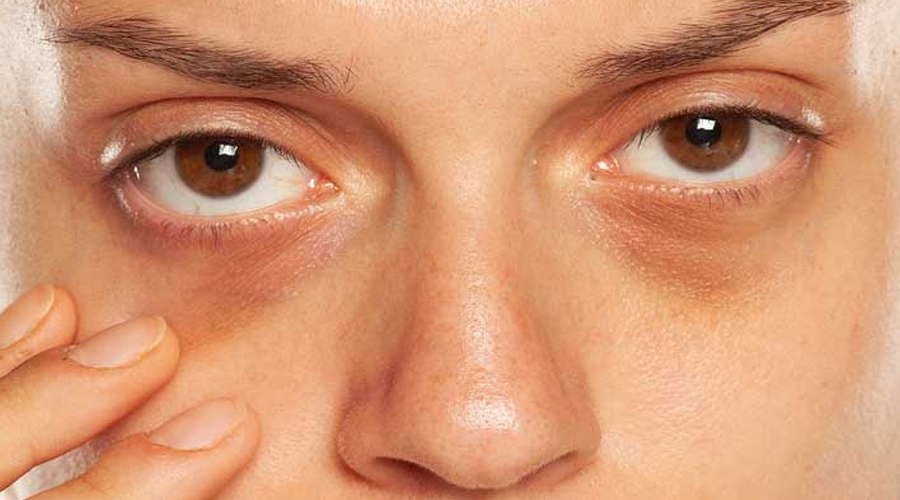 Dark Circles Treatment in Jaipur