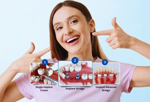 Dental Implant